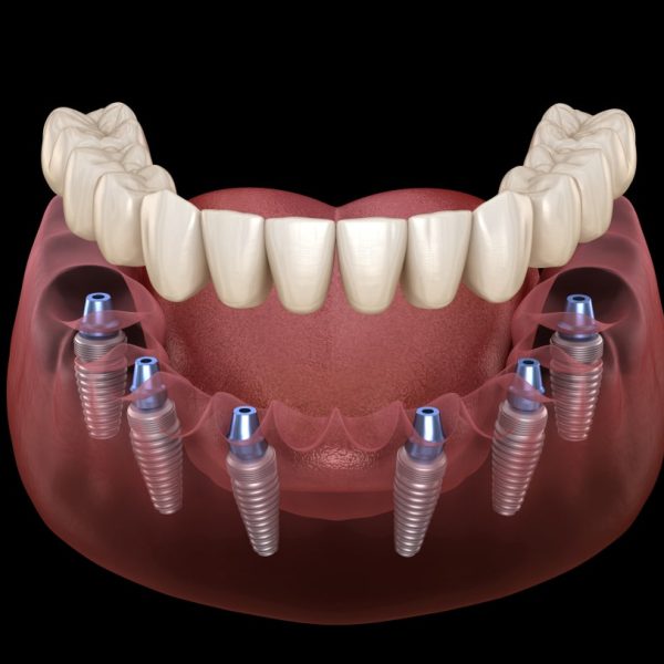 ALL-ON-6-IMPLANT