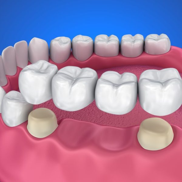 Dental-Bridge-Work