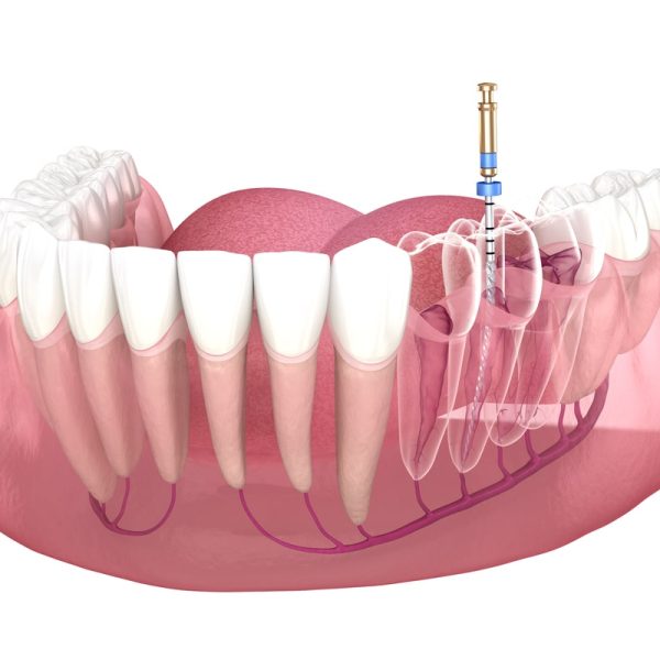 Root-Canal-Treatments-1